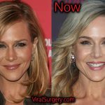 Julie Benz Plastic Surgery, Before After Boob Job, Botox Pictures