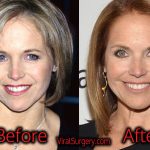Katie Couric Plastic Surgery: Before and After Facelift, Botox Pics
