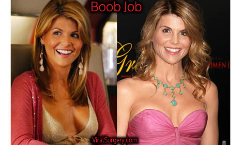 Lori Loughlin Plastic Surgery, Before and After Botox Pictures