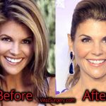 Lori Loughlin Plastic Surgery, Before and After Botox Pictures