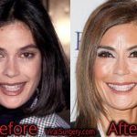 Teri Hatcher Plastic Surgery, Before and After Facelift Pictures