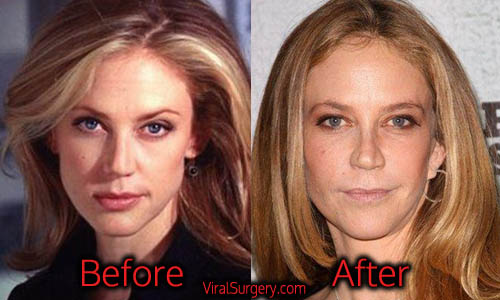 Ally Walker Plastic Surgery, Before and After Nose Job Pictures.