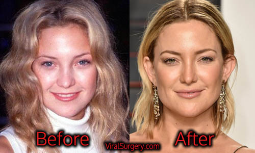 Kate Hudson nose job and boob job are popular enough. 