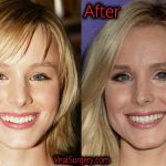 Kristen Bell Plastic Surgery, Before and After Pictures