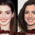 Anne Hathaway Plastic Surgery, Before After Nose, Boob Job Photos