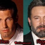 Ben Affleck Plastic Surgery, Before and After Botox, Fillers Pictures