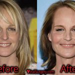 Helen Hunt Plastic Surgery, Before and After Facelift Pictures