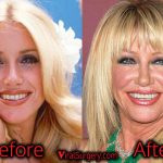 Suzanne Somers Plastic Surgery, Before and After Facelift Pictures