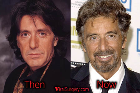 Al Pacino Facelift