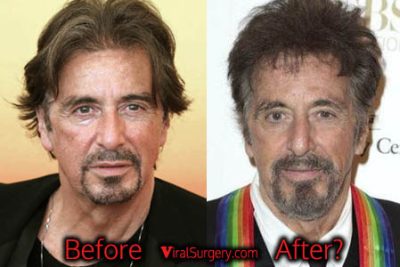 Al Pacino Plastic Surgery
