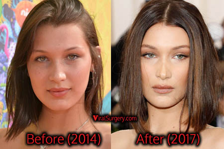 Bella Hadid Plastic Surgery: Before After Nose Job Pics - ViralSurgery.com