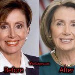 Nancy Pelosi Plastic Surgery