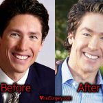 Joel Osteen Plastic Surgery, Before and After Botox Picture