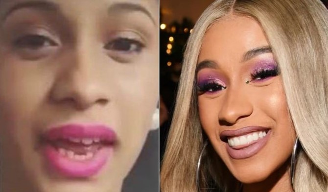 Cardi B’s teeth before and after surgery. 
